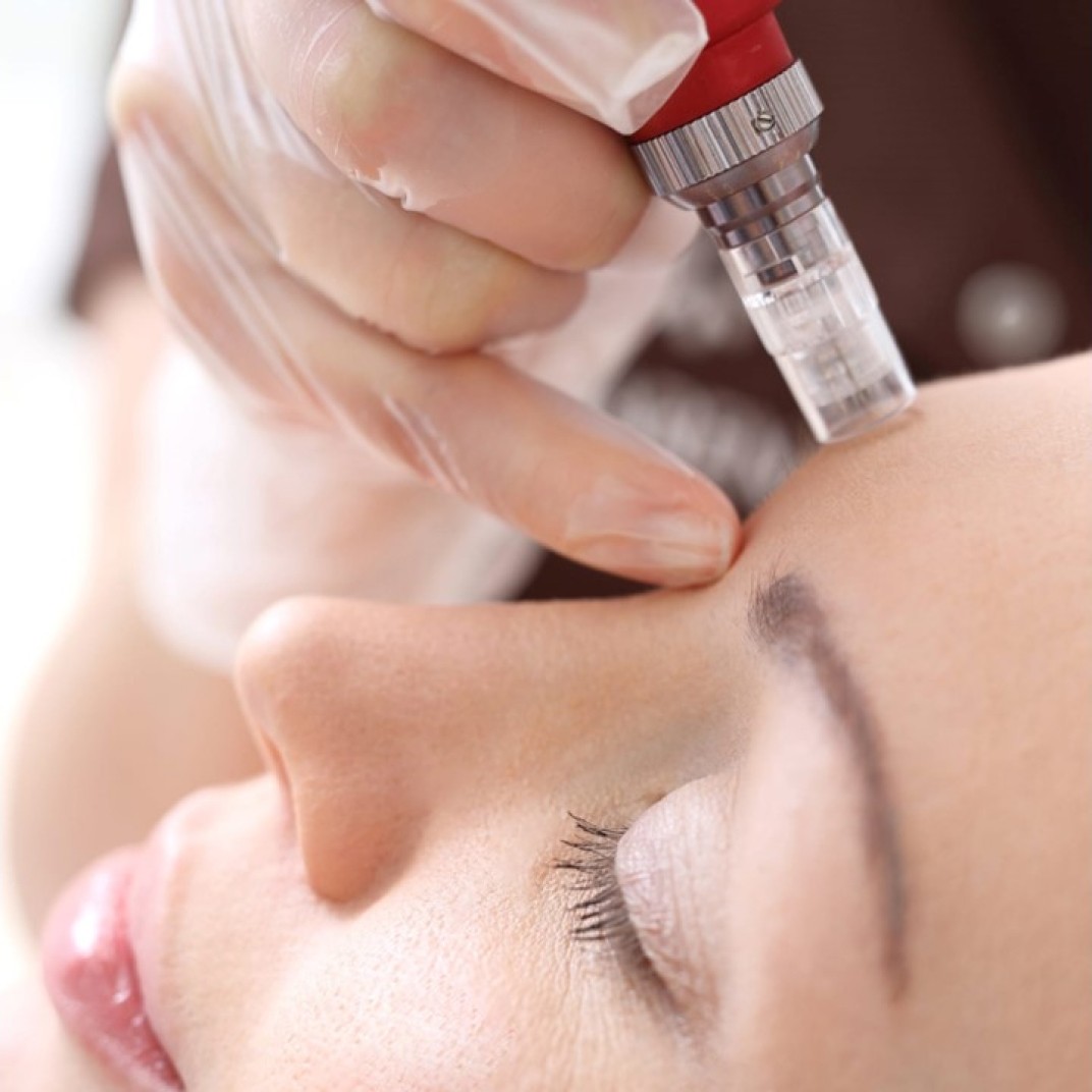 Woman getting her forehead micro-needled