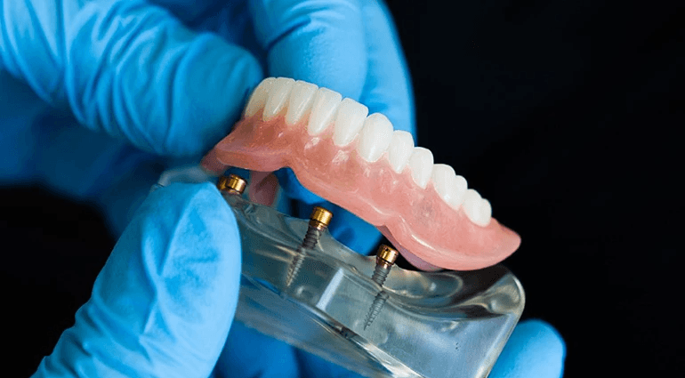 Snap-on denture