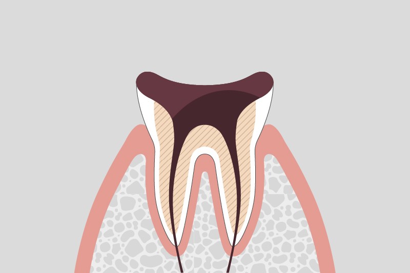 むし歯の進行段階とその治療方法