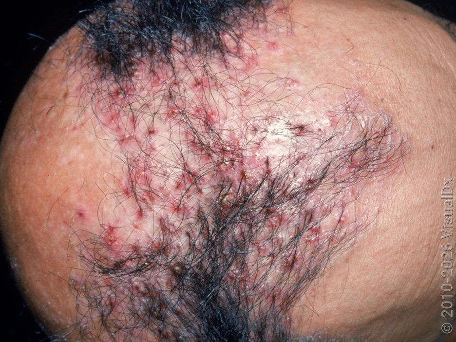 Folliculitis Decalvans — image from NorCal Hair Doctor™'s existing website
