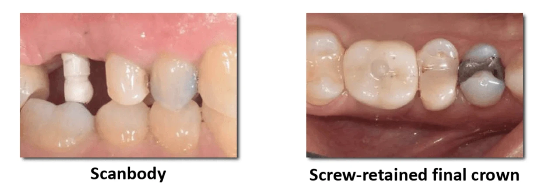 From Scanbody to Implant Supported Crown: No Impressions | Bloor-Yorkville Periodontics