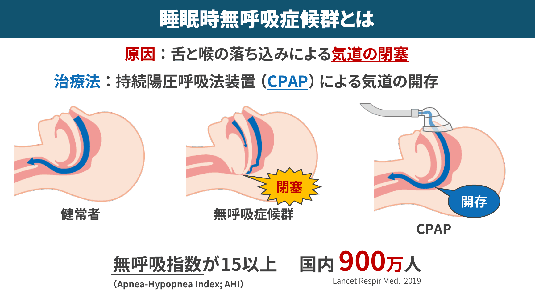 睡眠時無呼吸症候群（SAS）とCPAP治療
