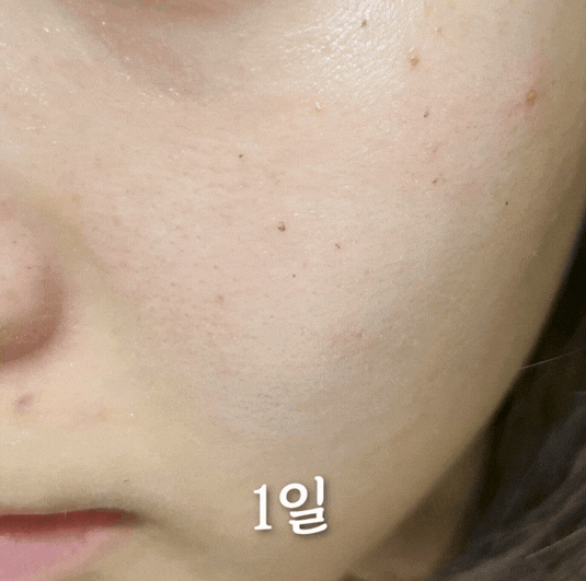 얼굴 잡티 레이저 추천 - 홍대 뷰티스톤의원 서울대 전문의 위영진