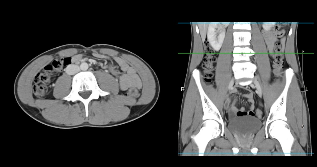 ct scan images of a lumbar spine