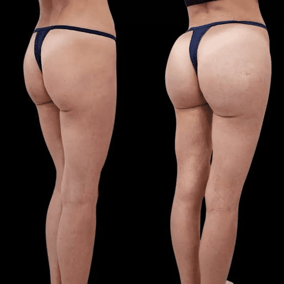 What Are Buttock Fillers and How Do They Work?