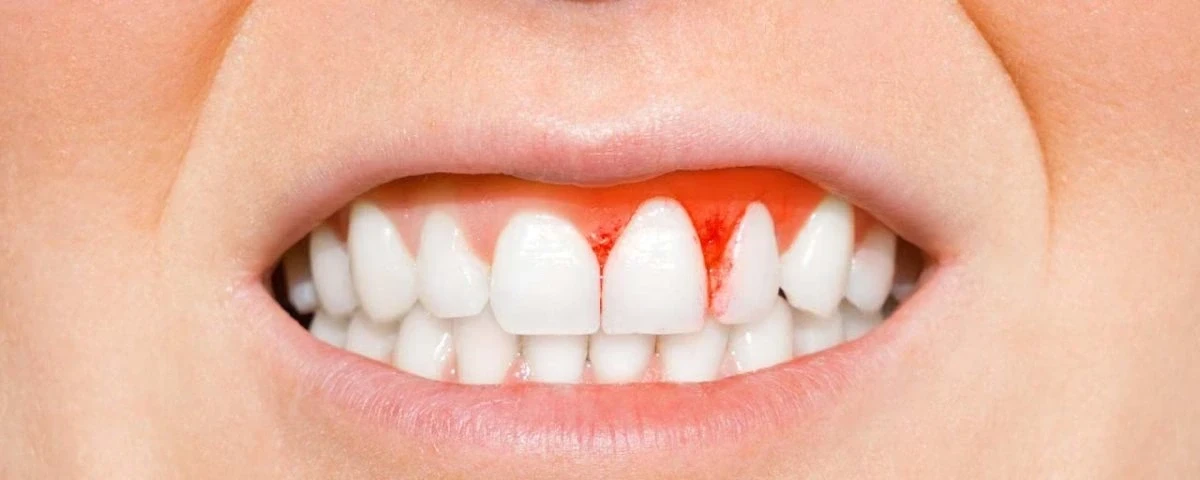 gum disease treatment