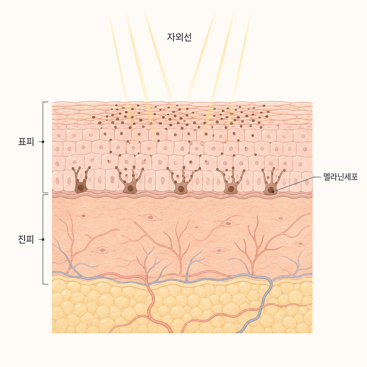 자외선이 약해진 피부 장벽을 자극해 멜라닌이 몰리는 모습