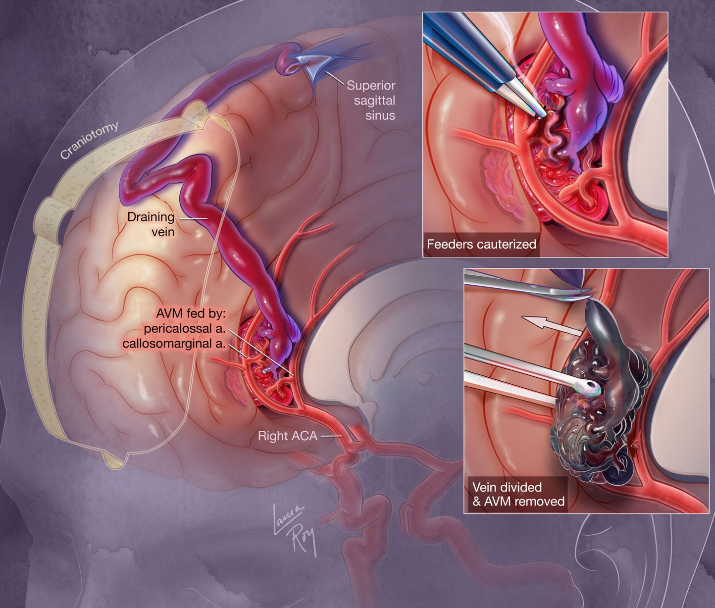Mesial AVM Surgical Overview