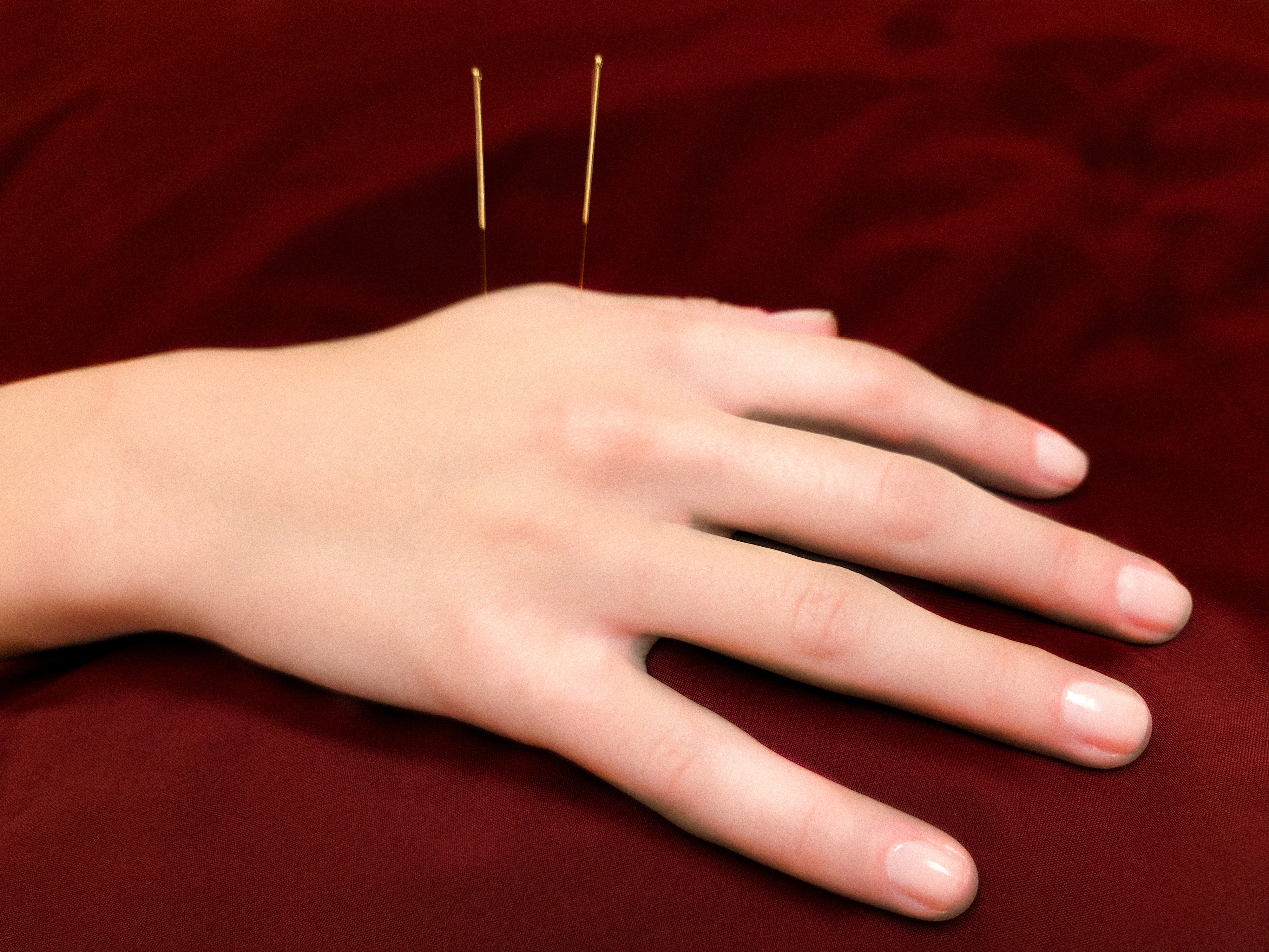 A hand sitting palms down, with two acupuncture needles sticking out the top