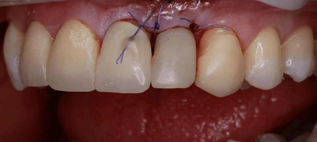 Foto zubov so zavedeným implantátom a dočasnou korunkou na hornom bočnom rezáku