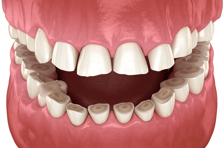teeth grinding