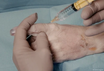 Digital Nerve Block - Finger