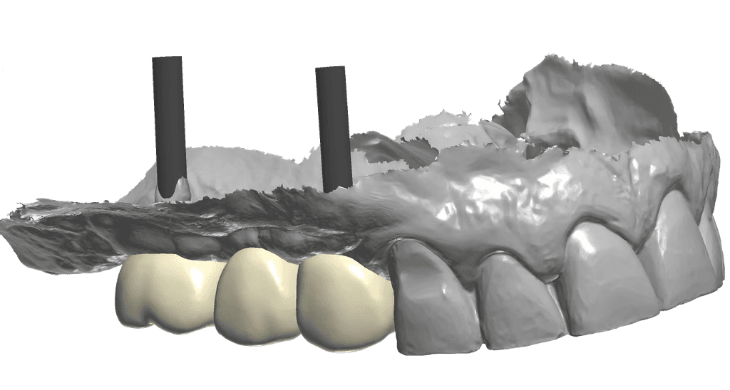 Digitálna modelácia mostíka na dvoch implantátoch