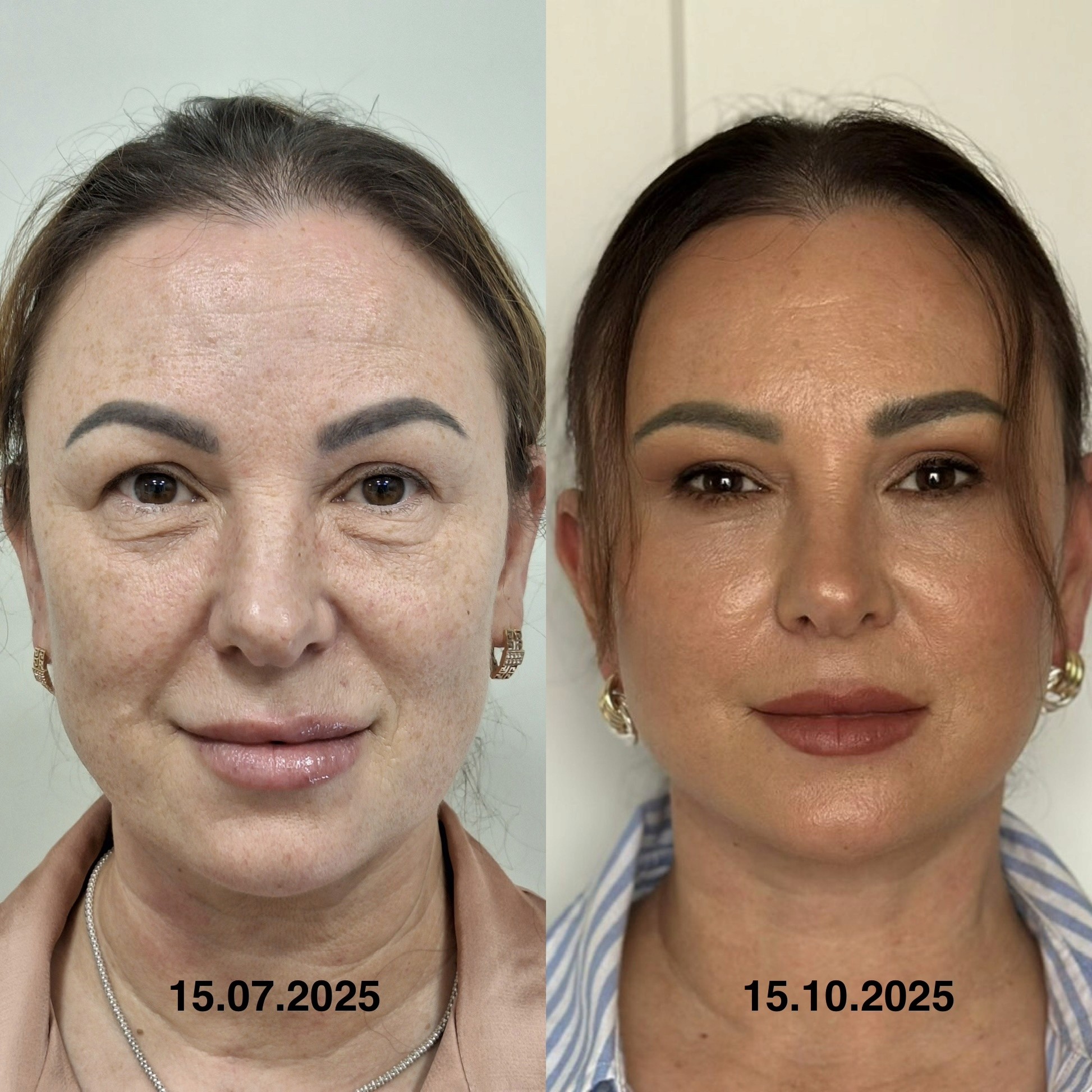 deep plane SMAS facelift before after front