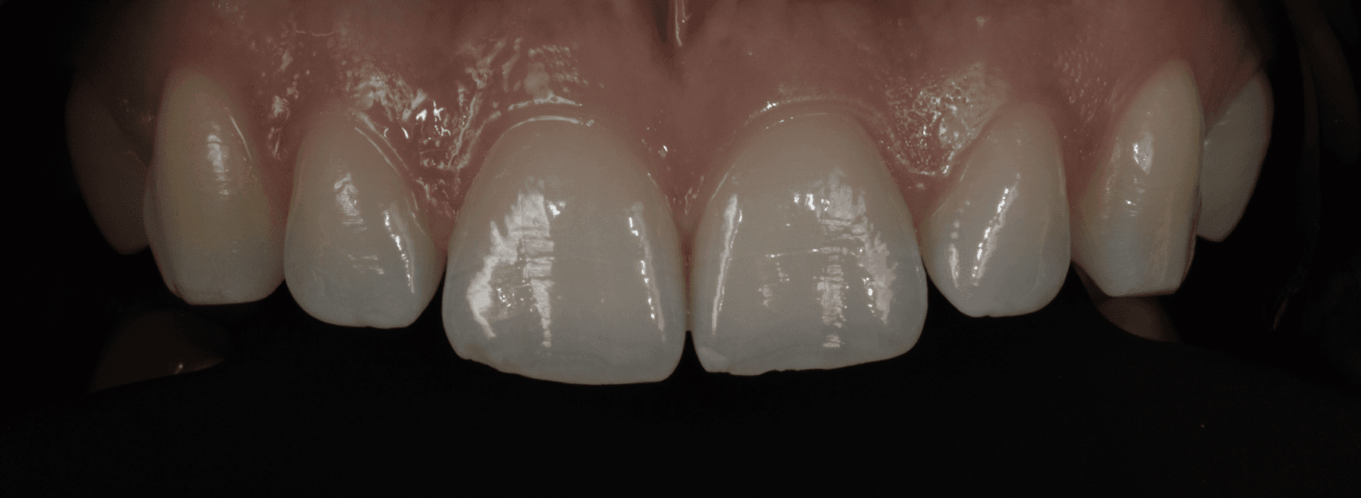 Funktionsdiagnostik und Zahnästhetik