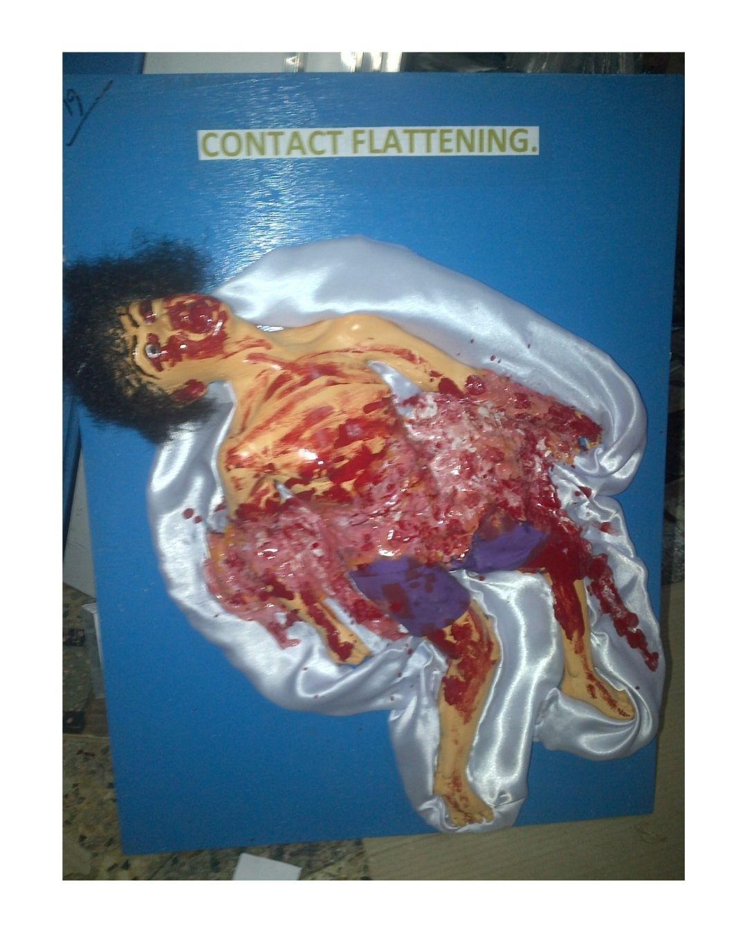 Contact Flattening Injury