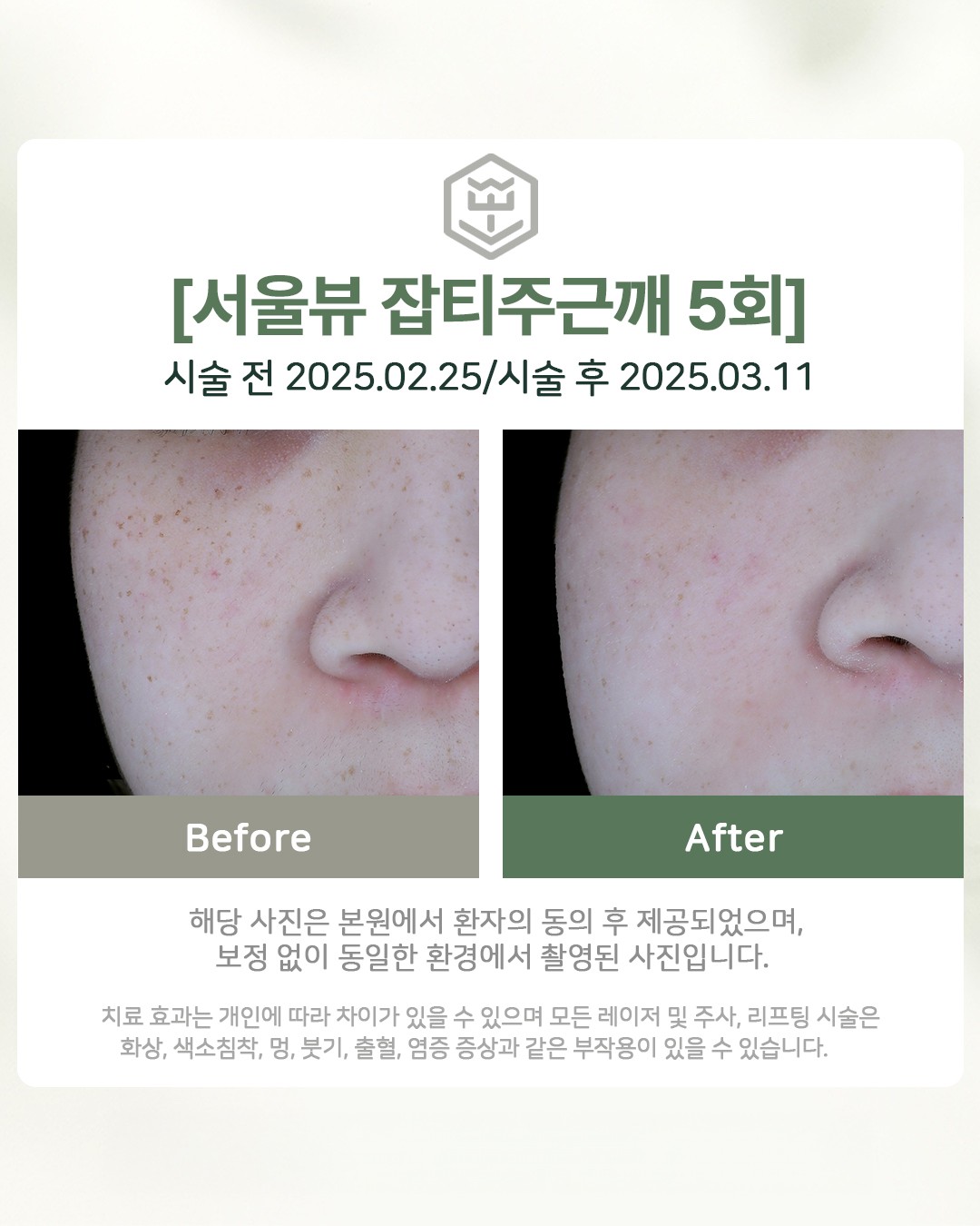 잡티주근깨 5회