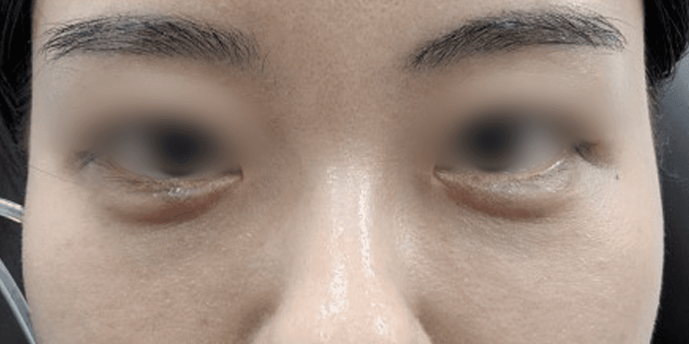 Undereye Filler - After