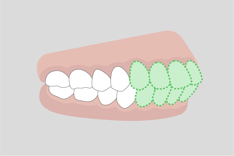 不正咬合の種類
