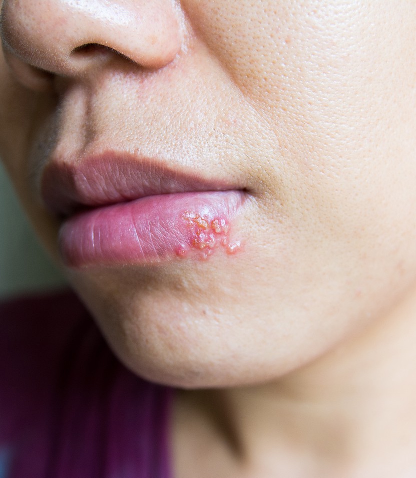 Fast Relief and Long-Term Control from Consultant Dermatologists