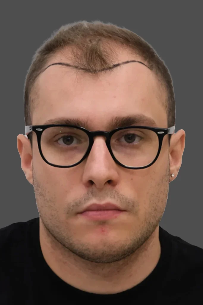 Präoperative Anzeichnung der Haarlinie bei schütterem Haar im Frontbereich