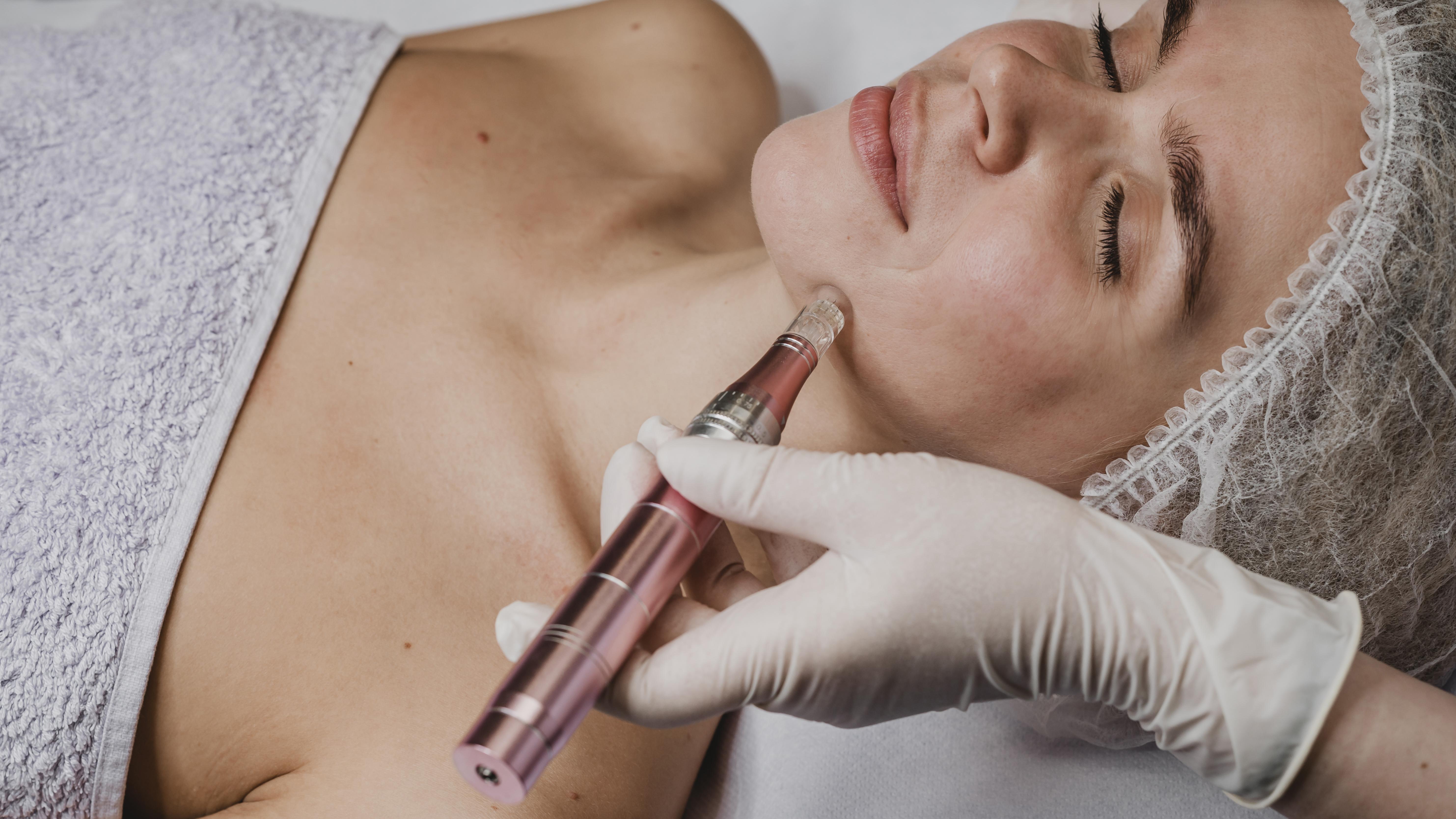 How Is Microneedling Performed?