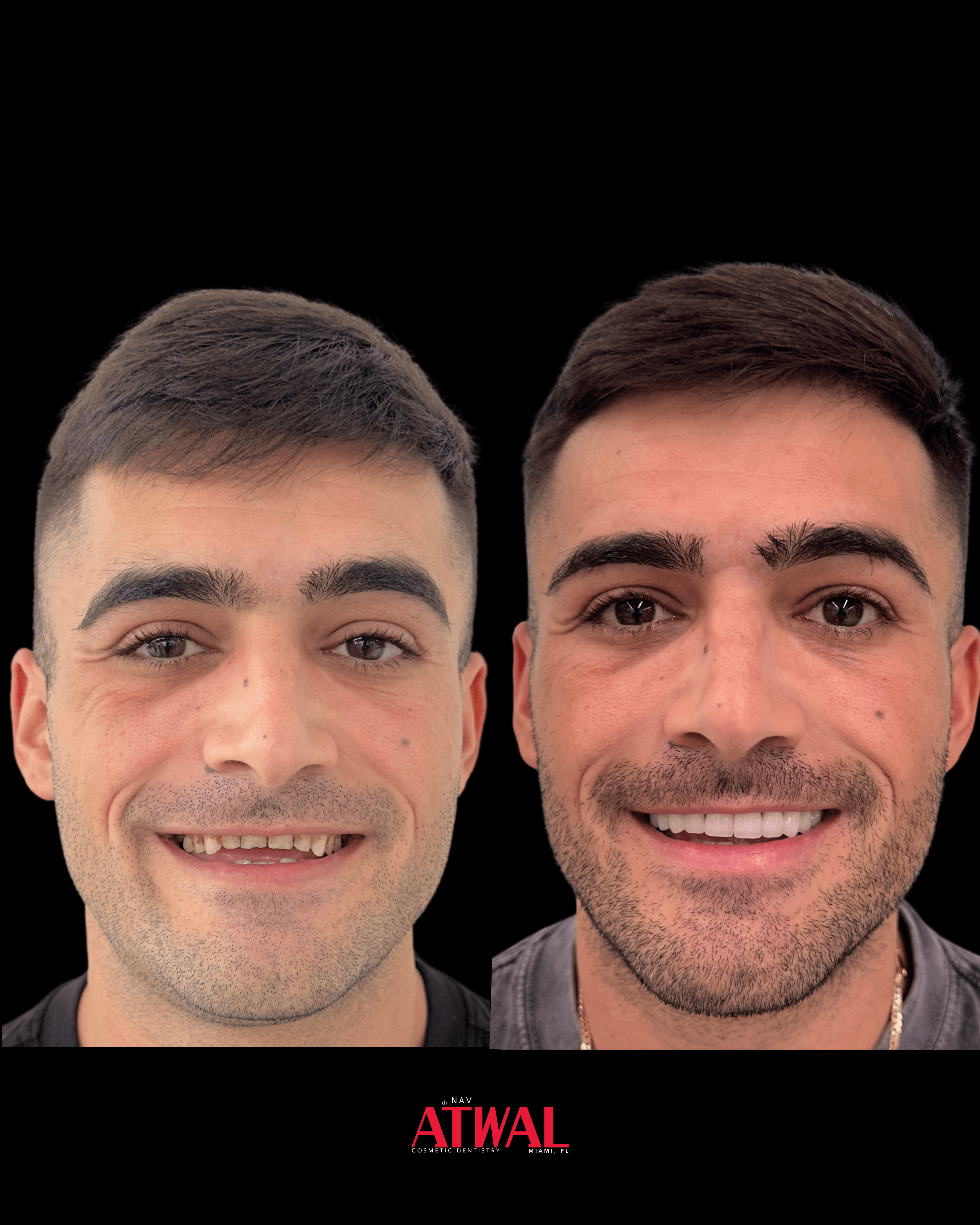 Full-mouth rehabilitation with veneers and crowns — Miami