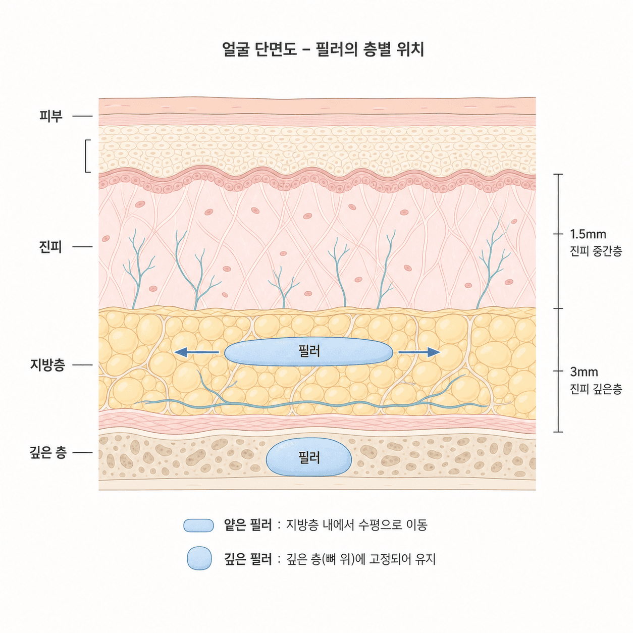 깊게 자리 잡은 필러와 얕은 층에서 조직면을 따라 밀리는 필러를 비교한 구조