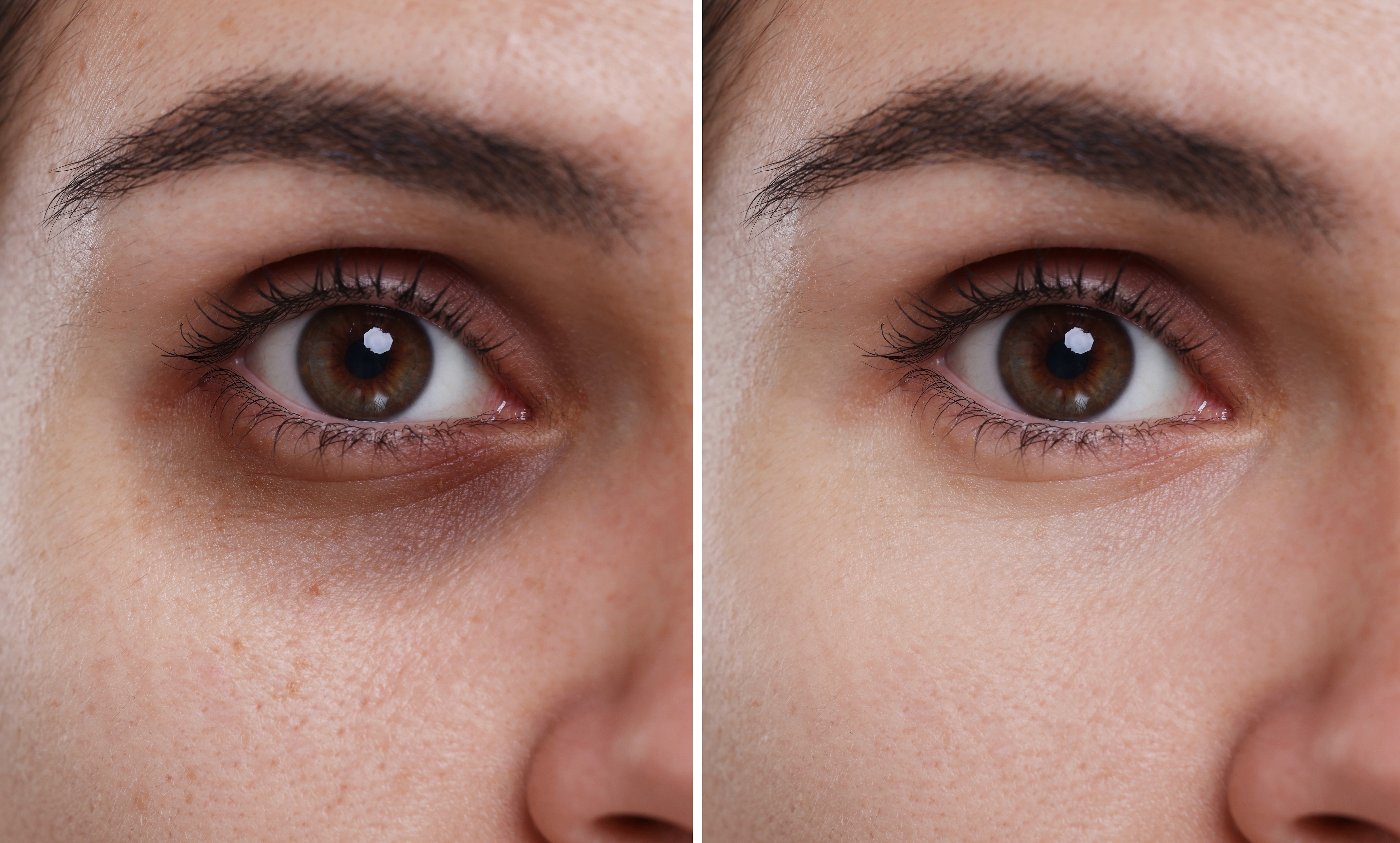 before and after dark circle under eye treatment at bella dermatology clinic in Abu Dhabi