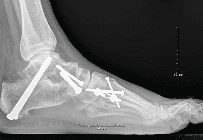 X-ray for Triple Arthrodesis Treatment