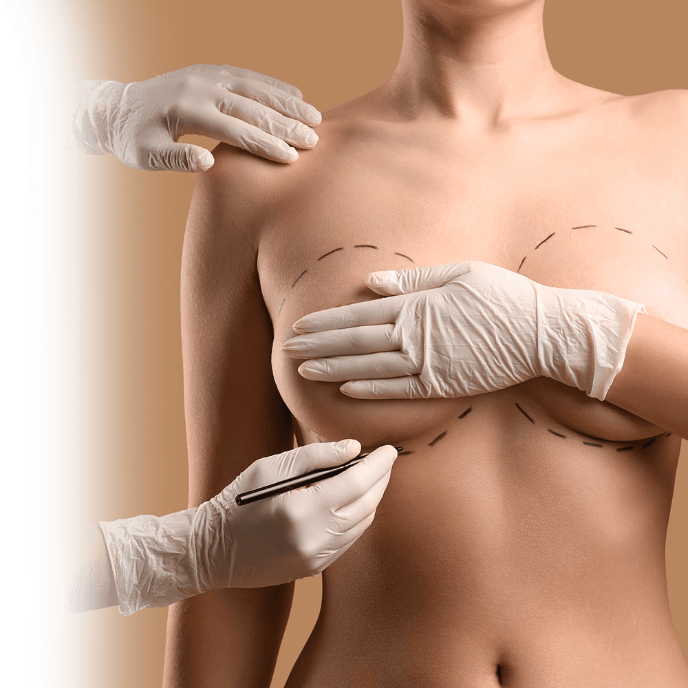 surgical planning of breast implant