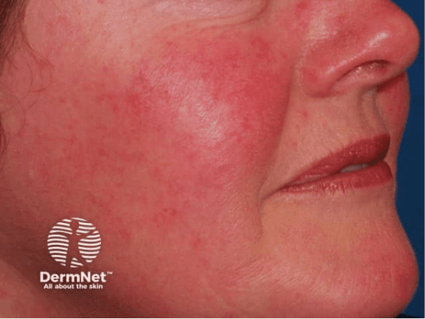 Rosacea symptoms on fair skin, including persistent facial redness and inflamed bumps