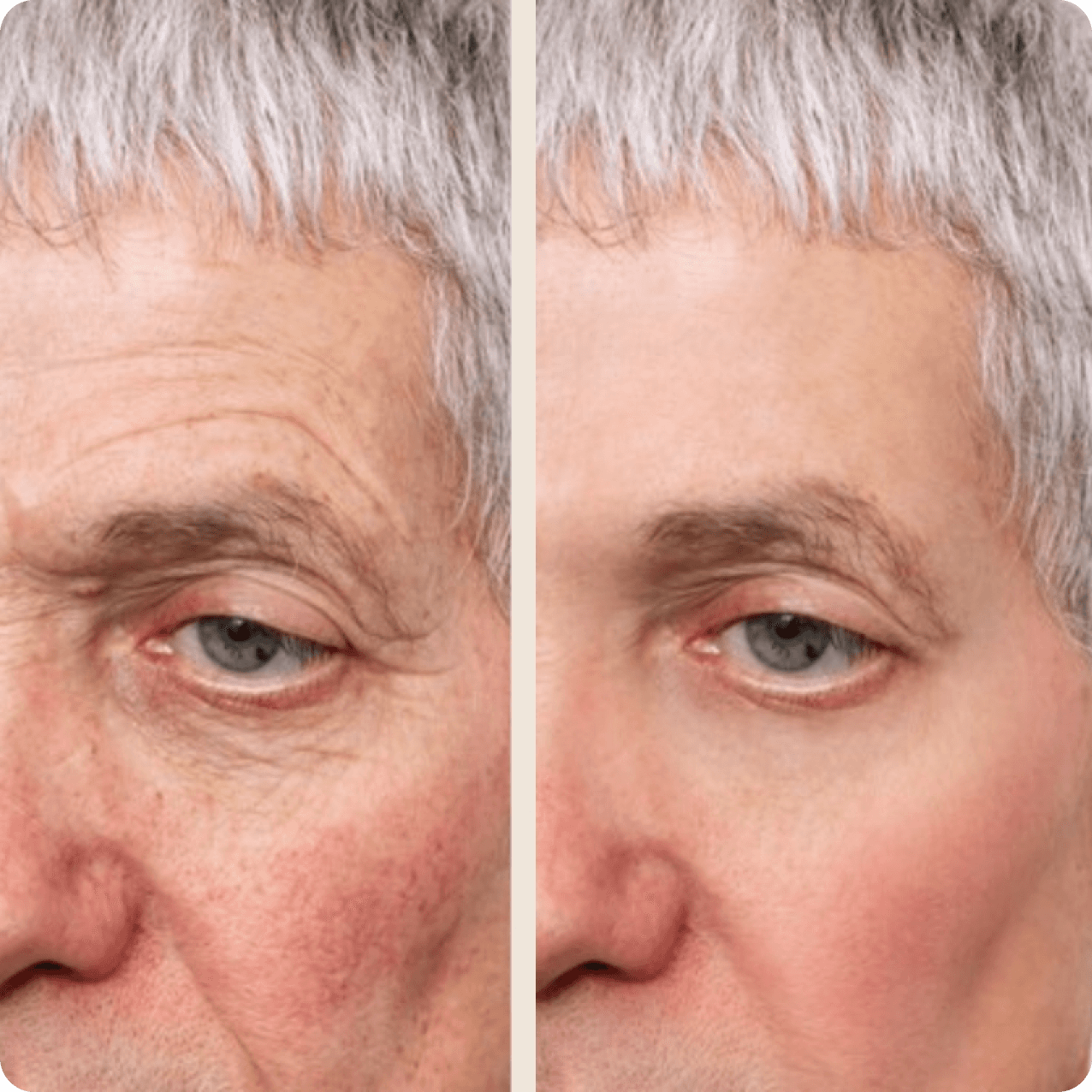 Before-and-after comparison of a man's face showing the results of blepharoplasty. In the 'before' image, the man has sagging skin and puffiness around the eyelids, while the 'after' image reveals smoother, firmer eyelids with a more refreshed and youthful appearance. The man has a neutral expression in both images, highlighting the transformation achieved through the surgery.