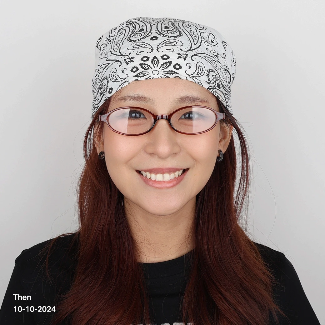 รีวิวออกแบบรอยยิ้มวีเนียร์ cosdent smile design