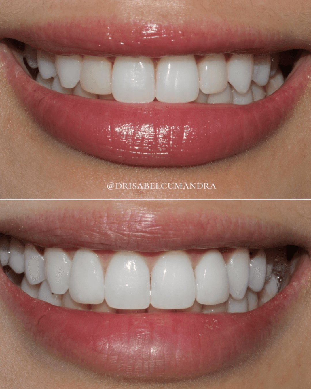 Before and After Whitening Treatment at ScarboroSmiles Dental Clinic in Scarborough, ON | Best dentist in Scarborough.