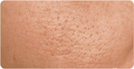 Enlarged pores and uneven surface
