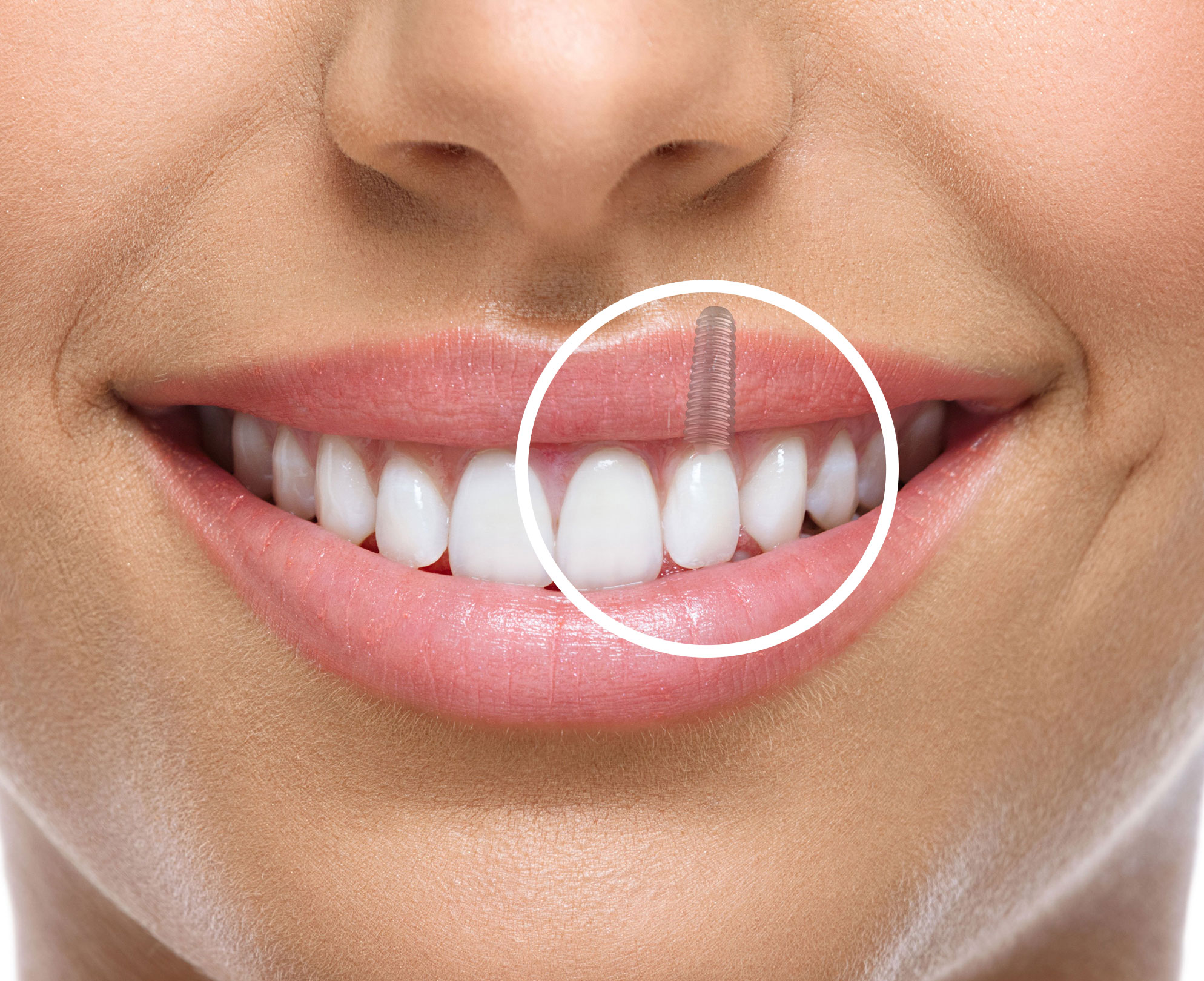 dental implants