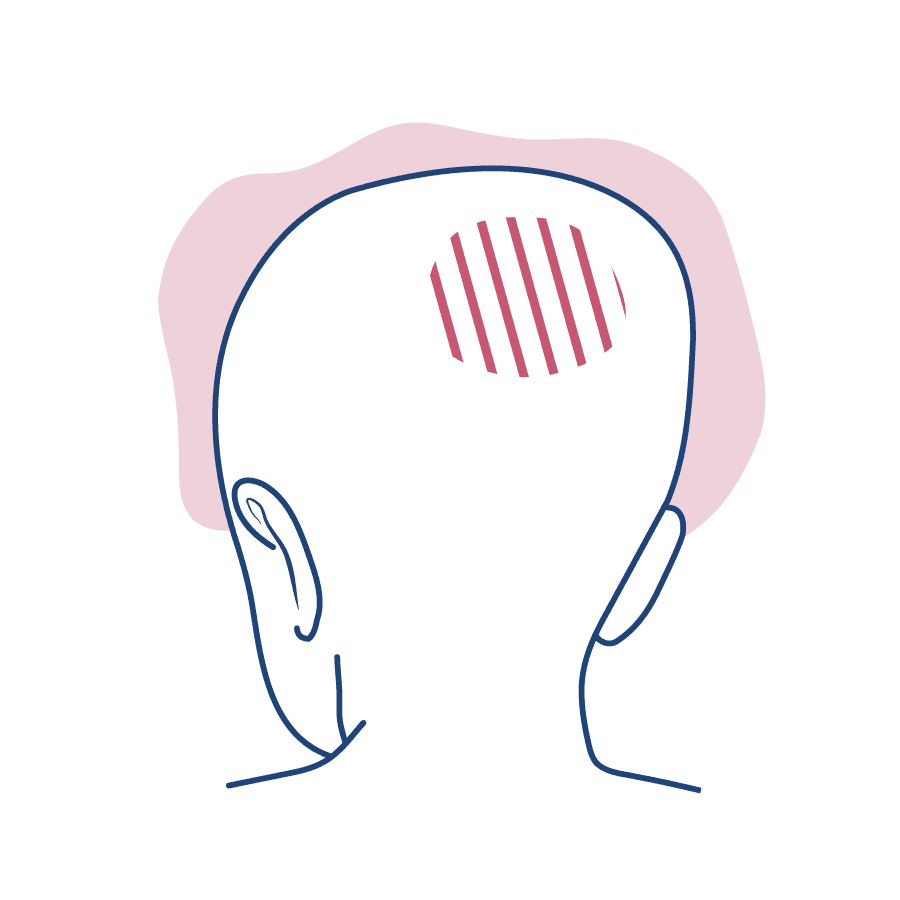 Ilustração de um homem de costas, com a parte da coluna sinalizada, representando a dor na região.