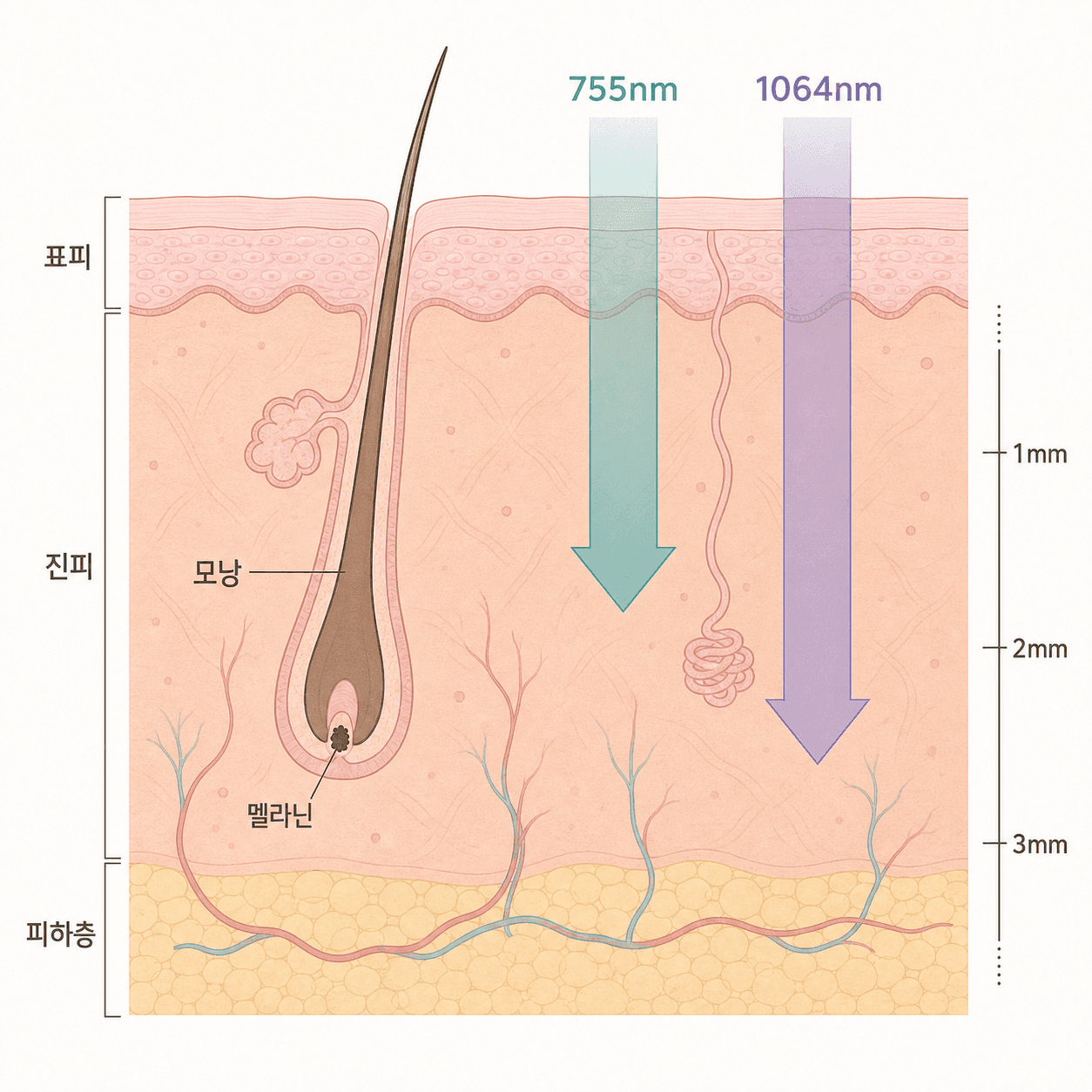 755nm·1064nm 파장이 모낭 멜라닌에 집중되는 깊이