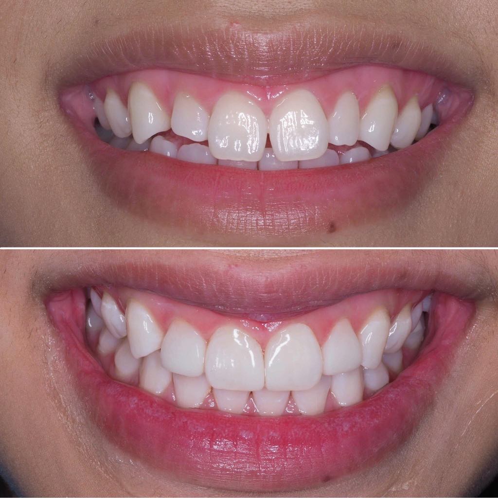 Before & After