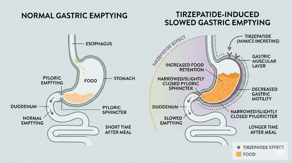 How tirzepatide causes bloating by slowing gastric emptying