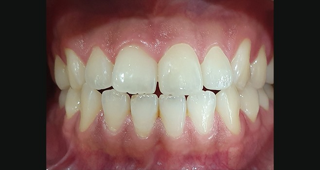 심미 지르코니아 세팅후 사진