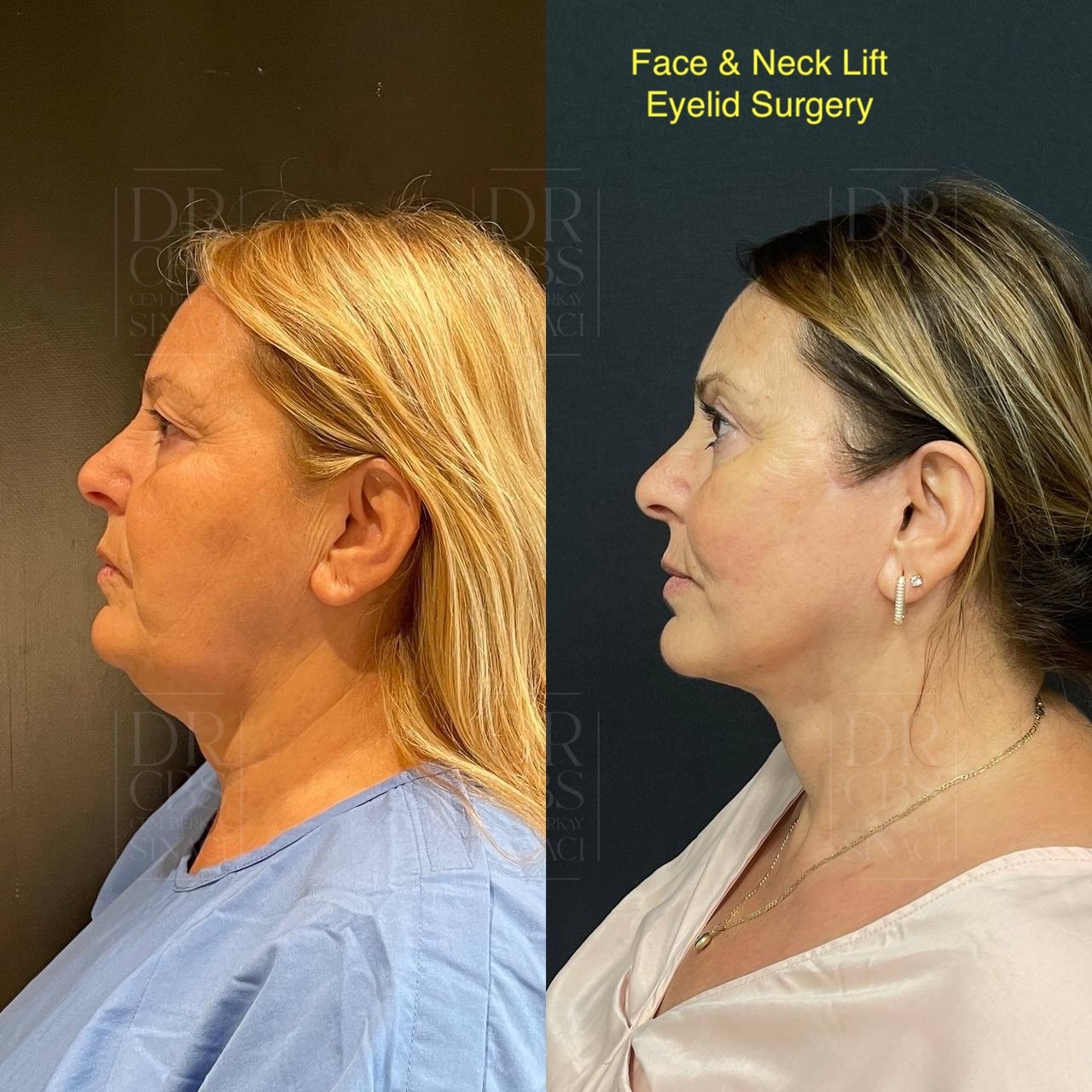 High SMAS facelift and upper blepharoplasty 5 months result before after side view