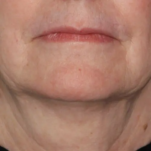 After peptide therapy at The Vancouver Aesthetician — neck and jowl sagging visibly lifted, wrinkles smoothed and facial contour improved