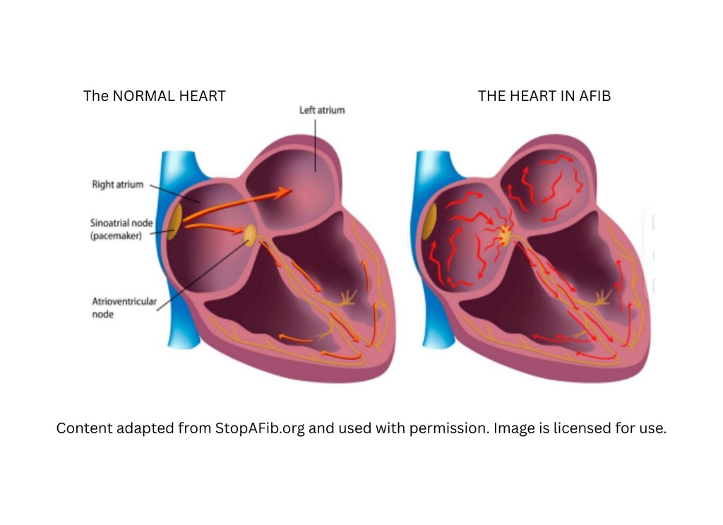 What is Atrial Fibrillation (AFib)? - Vasculearn Network (VLN)