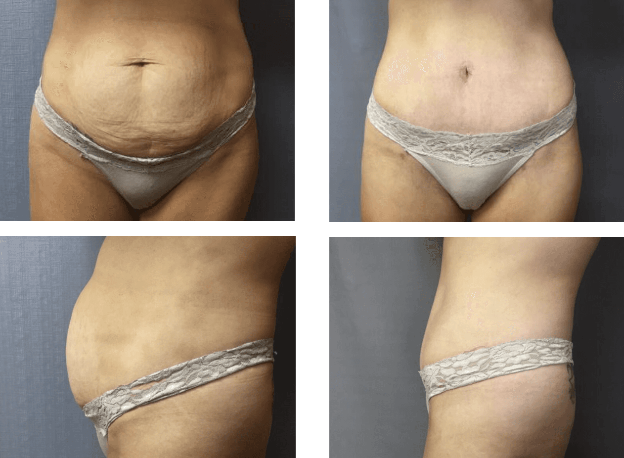 Before and after of surgery image
