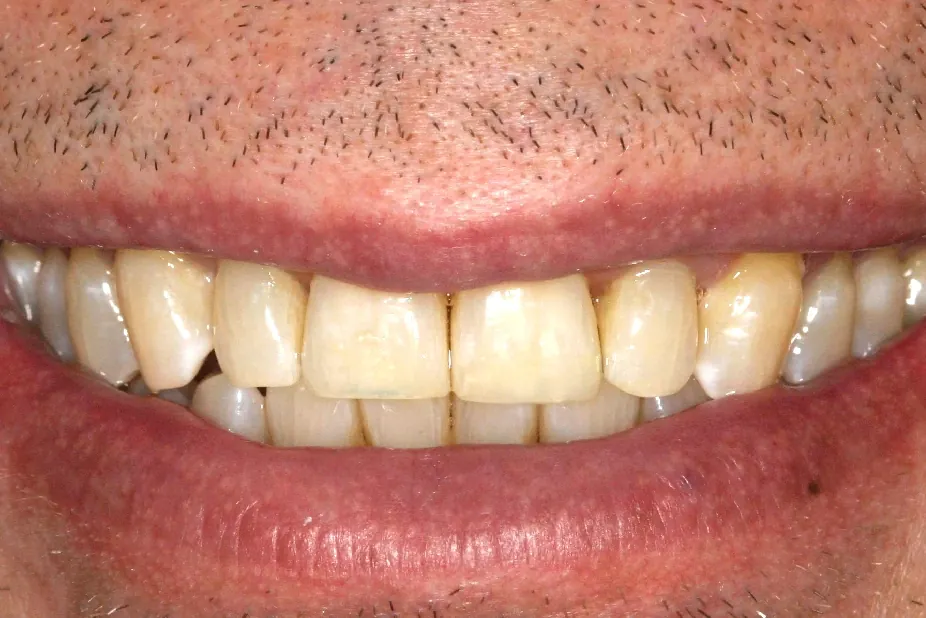 After: straight, beautiful teeth