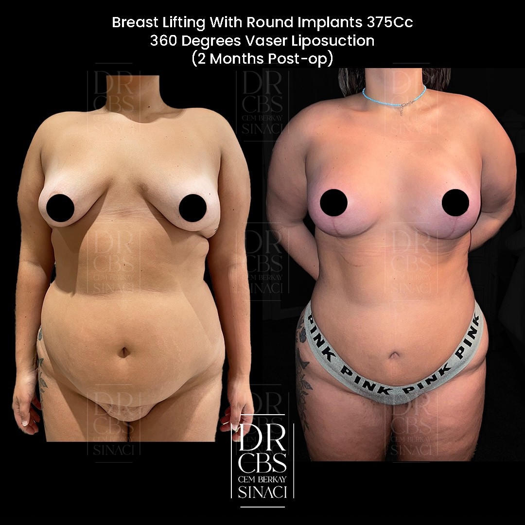 tuberous breast deformity before after of breast lift with implant front view