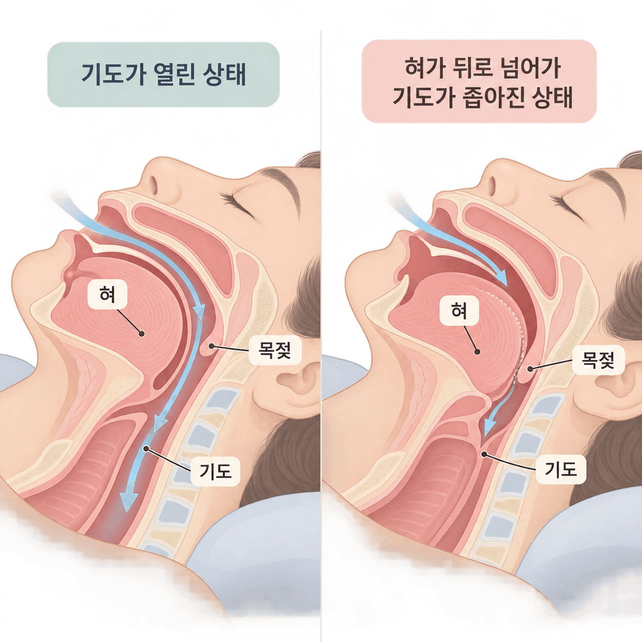 진정이 깊어지면 혀뿌리가 뒤로 처져 기도가 좁아질 수 있어요