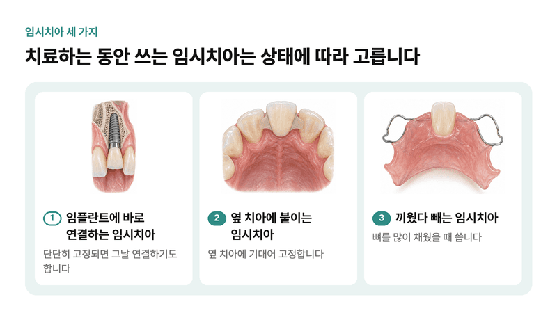 임플란트에 바로 연결하는 임시치아, 옆 치아에 붙이는 임시치아, 끼웠다 빼는 임시치아까지 앞니 임플란트 동안 쓰는 세 가지 임시치아를 비교한 일러스트